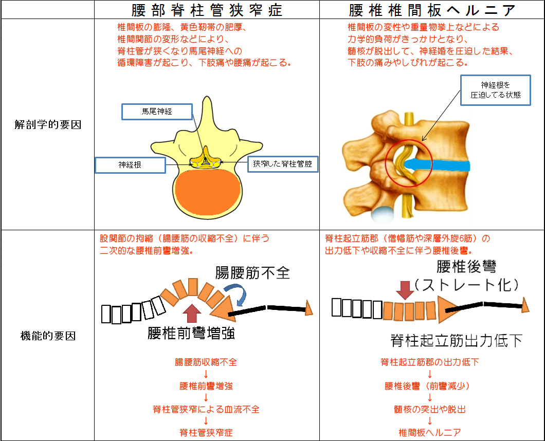 腰椎椎間板ヘルニア - 長崎県のスポーツ障害専門の整骨院
